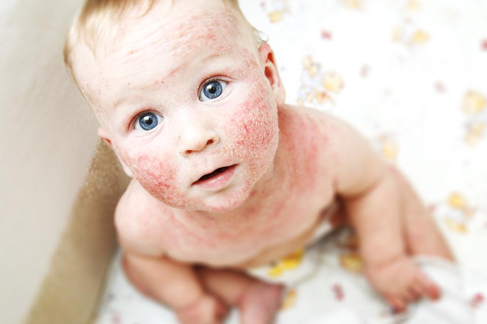 Atopijski dermatitis kod beba i djece: Dermatologinja prof. Brajac  objanjava uzroke, simptome i lijeenje | missMAMA