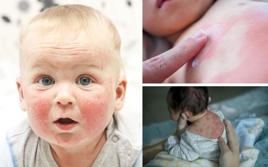 Atopijski dermatitis u djece | Author: Shutterstock