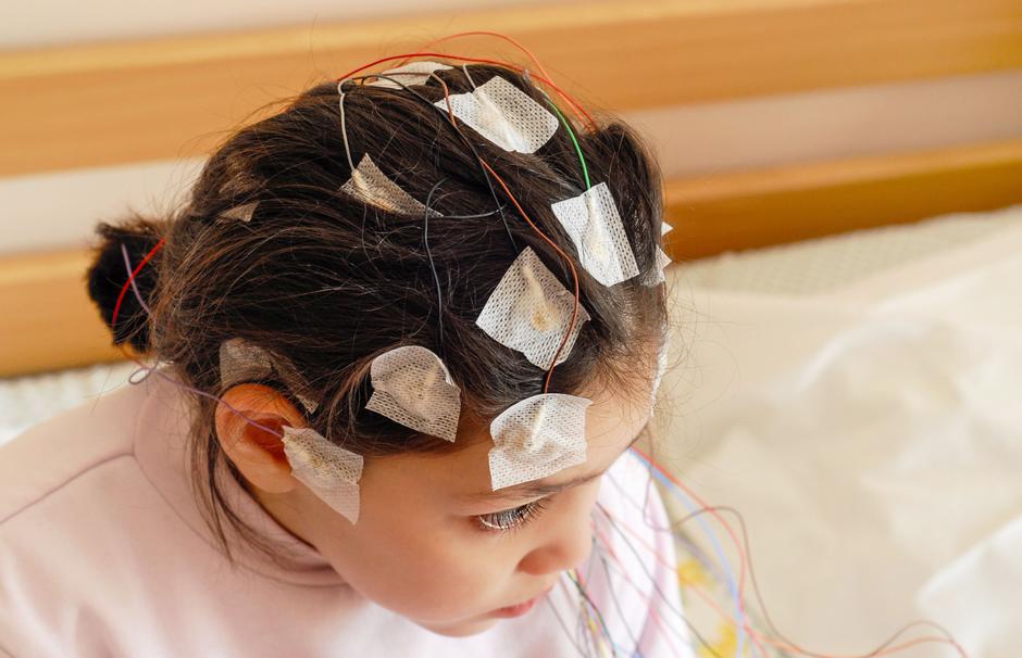 epilepsija kod djece | Author: Shutterstock
