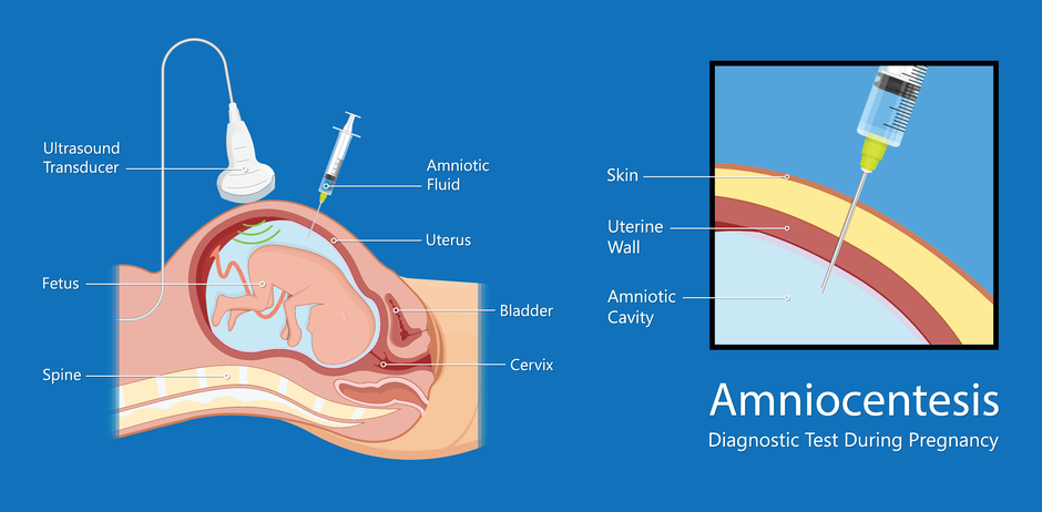 Amniocenteza | Author: Shutterstock