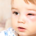 alergija dijete
