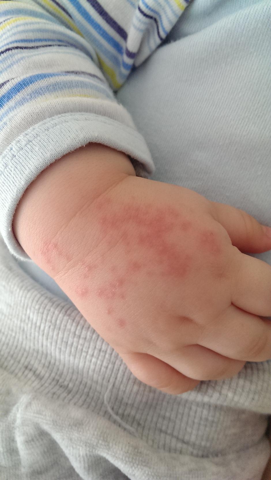 osip beba dijete dermatitis virus | Author: Shutterstock