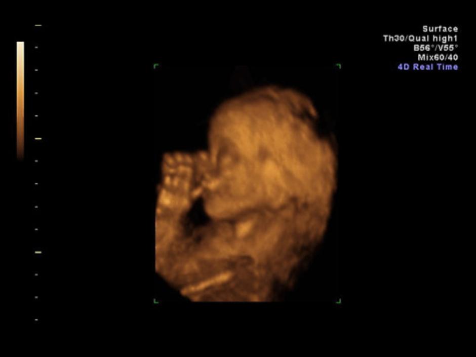 ultrazvuk, fetus | Author: Thinkstock