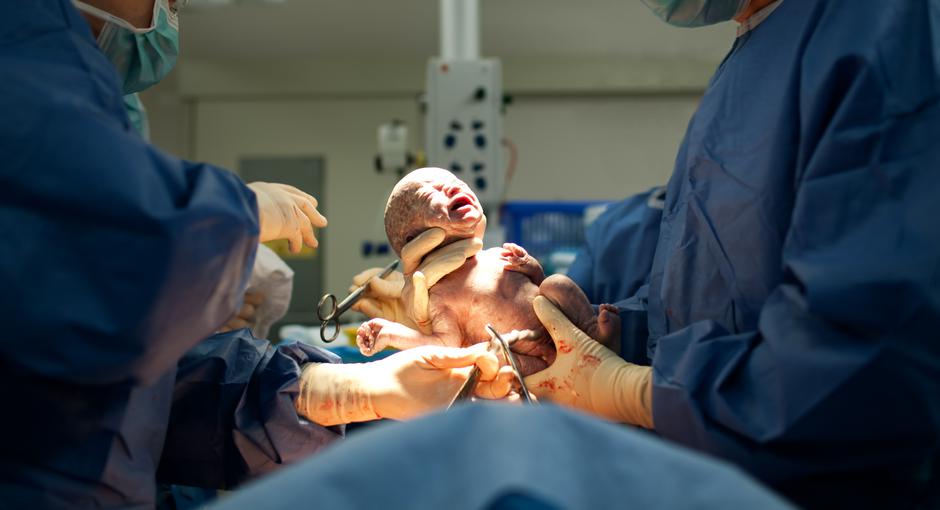carski rez porod rođenje | Author: Thinkstock