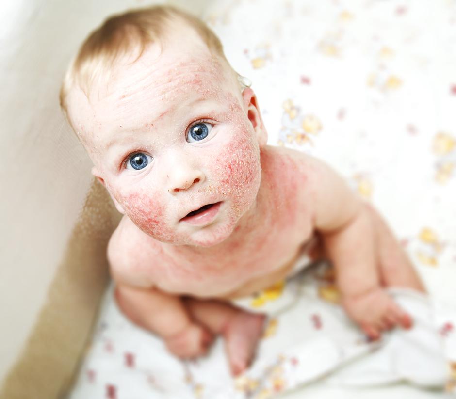 Atopijski dermatitis kod beba | Author: shutterstock