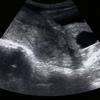 ultrazvuk spontani pobačaj