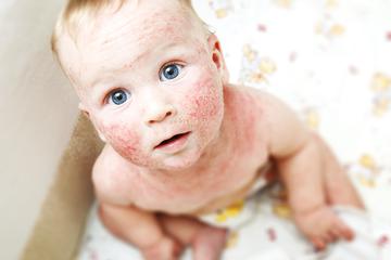 Atopijski dermatitis kod beba