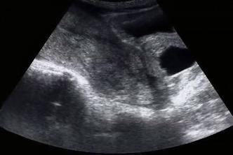 ultrazvuk spontani pobačaj