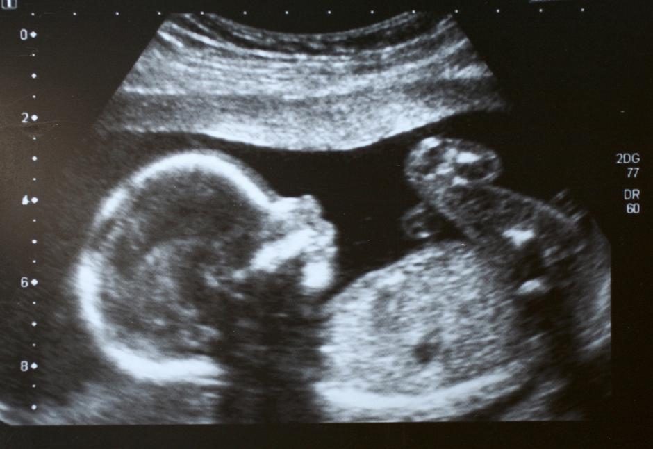 trudnica trudnoća fetus ultrazvuk beba | Author: Thinkstock