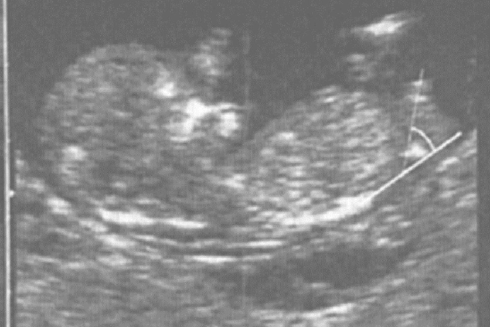 koliko su precizni rani ultrazvuci u trudnoći