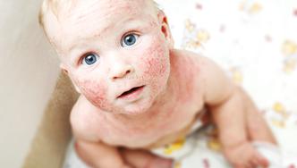 Atopijski dermatitis kod beba