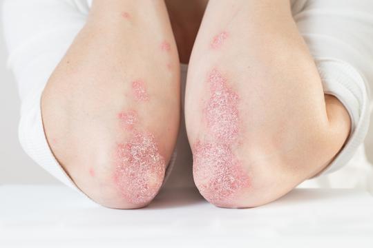 Psorijaza kod djece