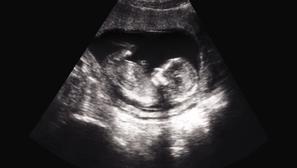 fetus ultrazvuk