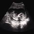fetus ultrazvuk
