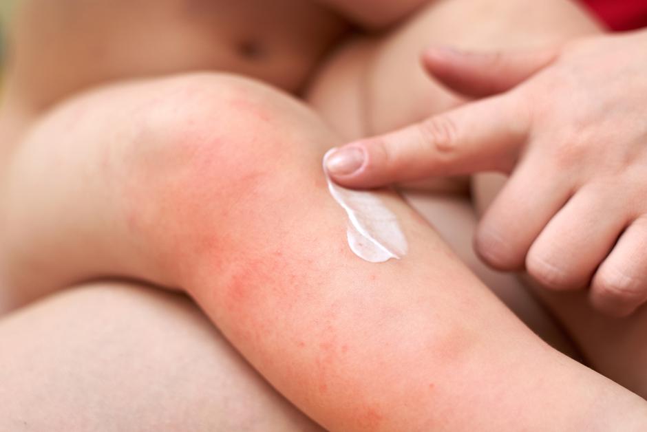 Alergije na sunce kod djece | Author: shutterstock