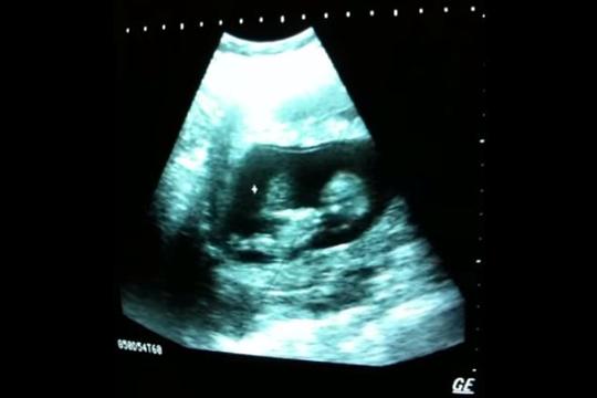 video, ultrazvuk